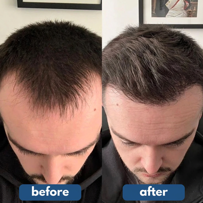 OUTLY® Hair Growth Roll on Serum